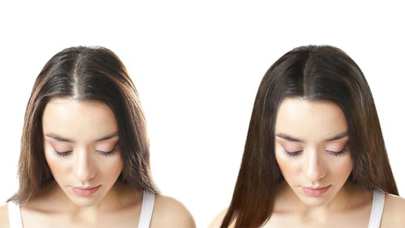 کاشت مو راه حلی برای درمان موهای ریخته شده جلوی سر
